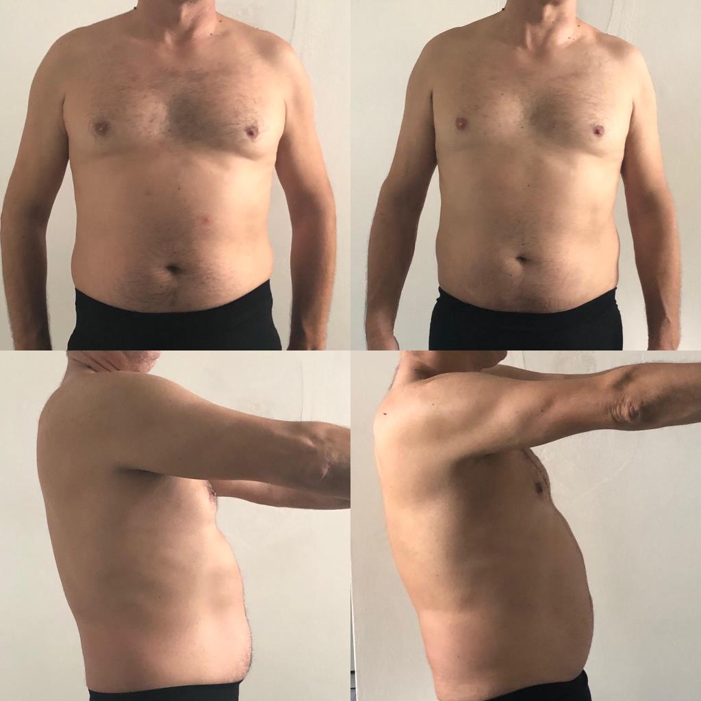 Avant/après 5 séances d'electrostimulation